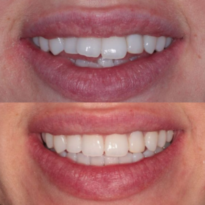 before and after smile Invisalign Teeth Straightening in Edinburgh
